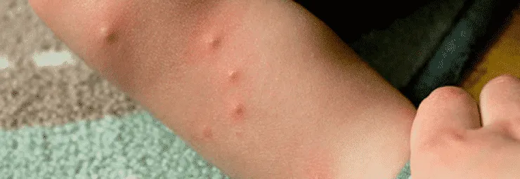 شكل قرصة البرغوث