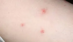 شكل قرصة البرغوث